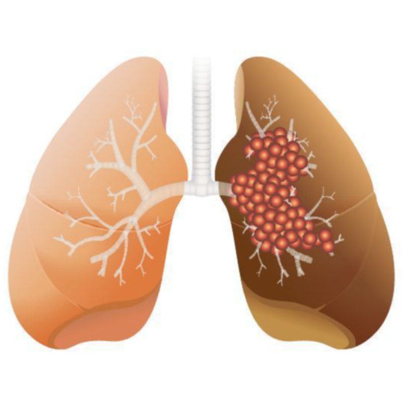 Suuri NMN -annos estää keuhkojen adenokarsinooman kasvua